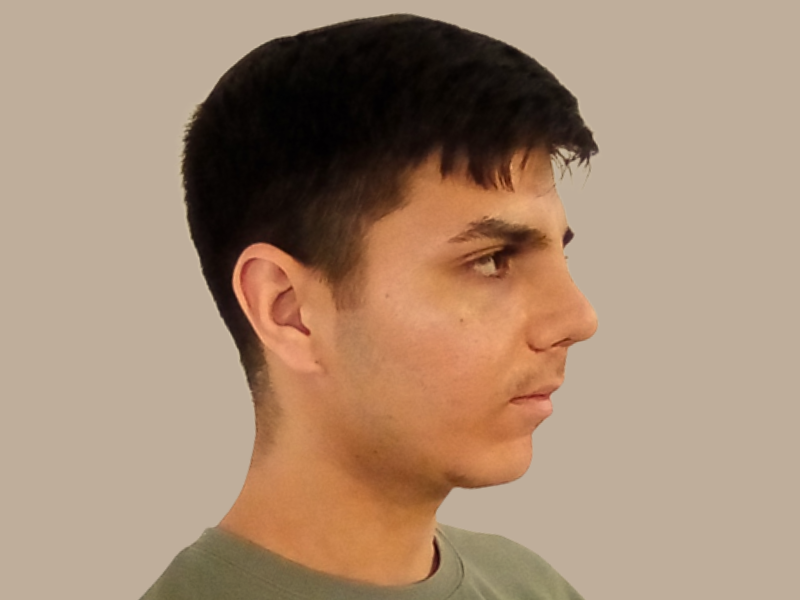 ניתוח אף אחרי