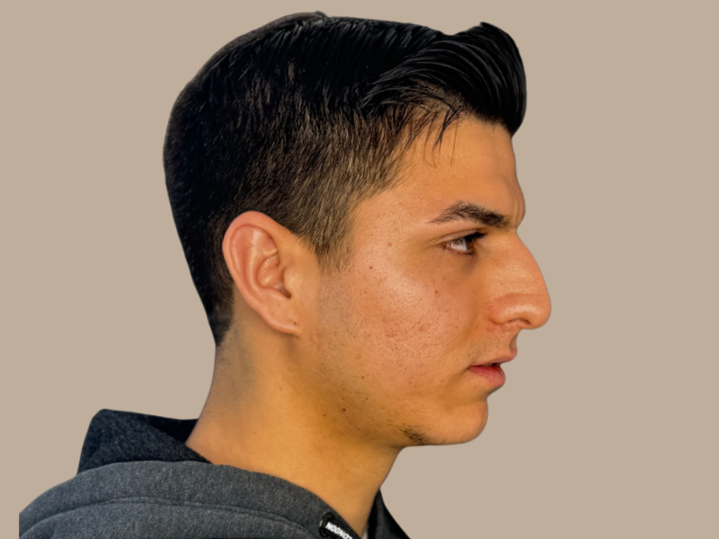 ניתוח אף לפני