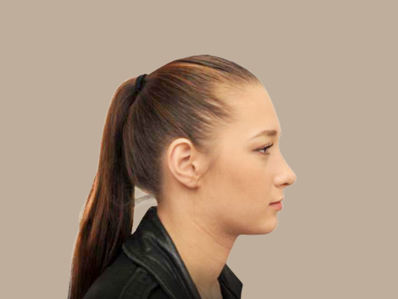 אחרי ניתוח אף