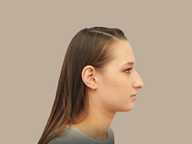 לפני ניתוח אף