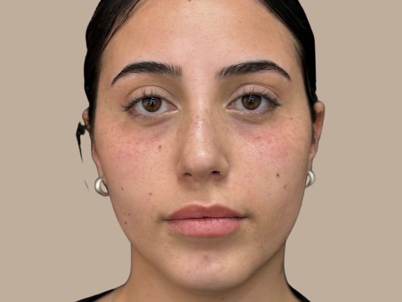 שקעיי עיניים לפני