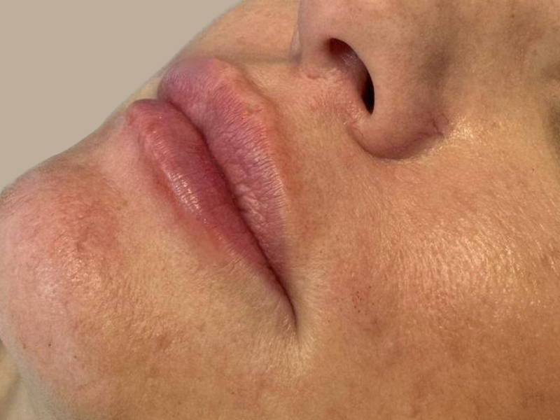 עיבוי שפתיים אחרי