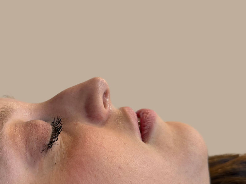 פיסול אף לפני