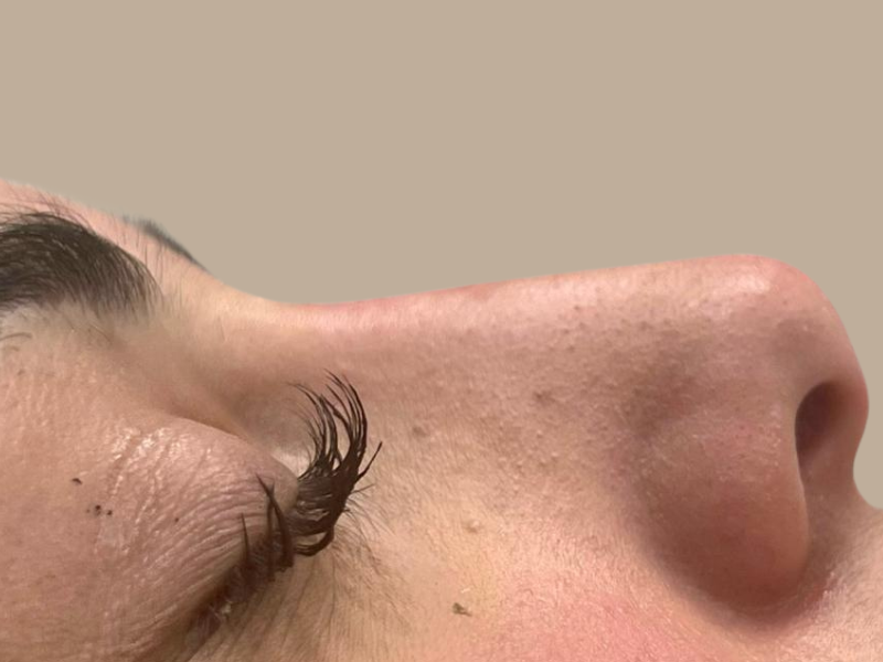 אחרי פיסול אף