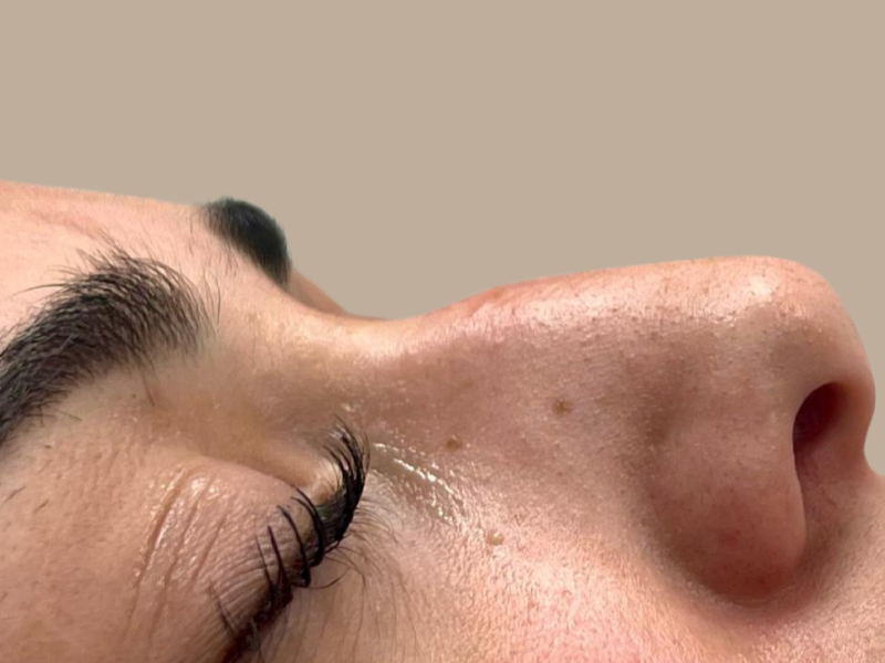 לפני פיסול אף