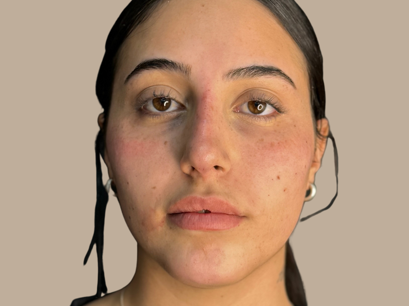 שקעי עיניים אחרי