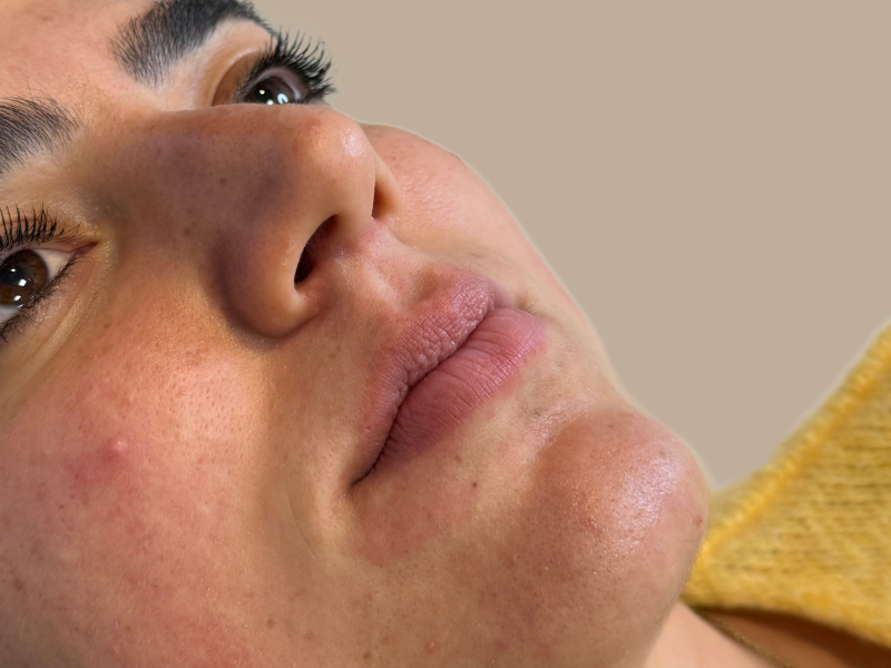 עיבוי שפתיים לפני