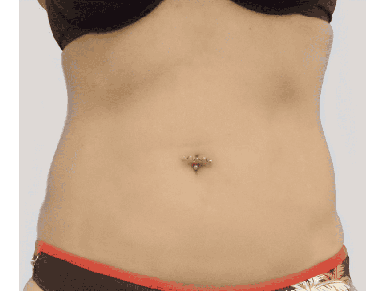 הקפאת-שומן-אחרי