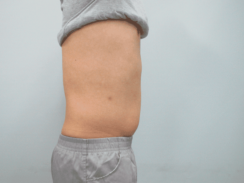 הקפאת-שומן-אחרי-2