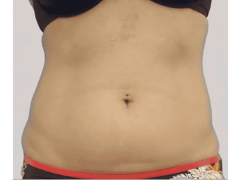 הקפאת-שומן-לפני