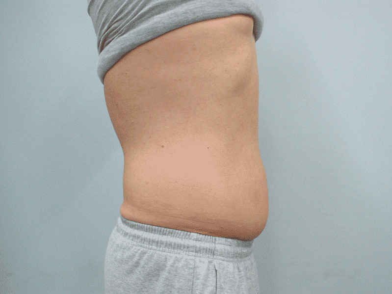 הקפאת-שומן-לפני