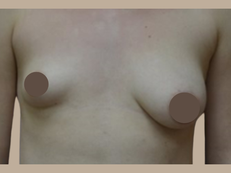 לפני הגדלת חזה