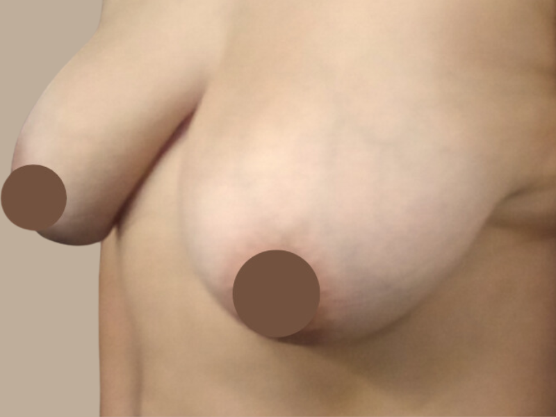 לפני הרמת חזה