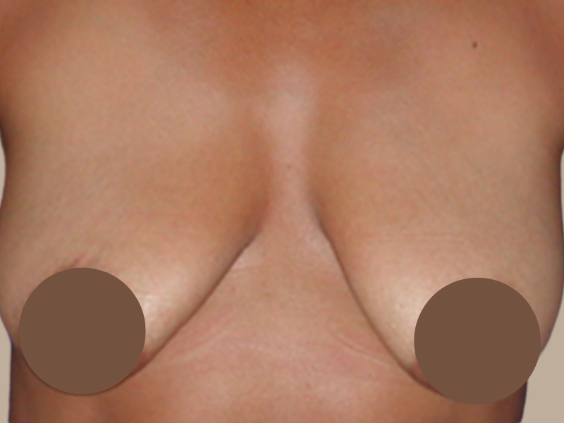 לפני הרמת חזה