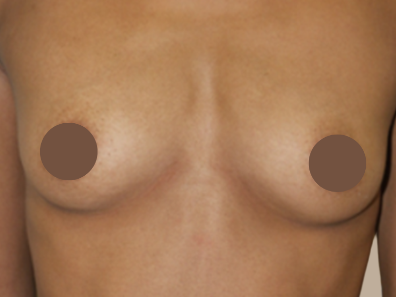 לפני הגדלת חזה