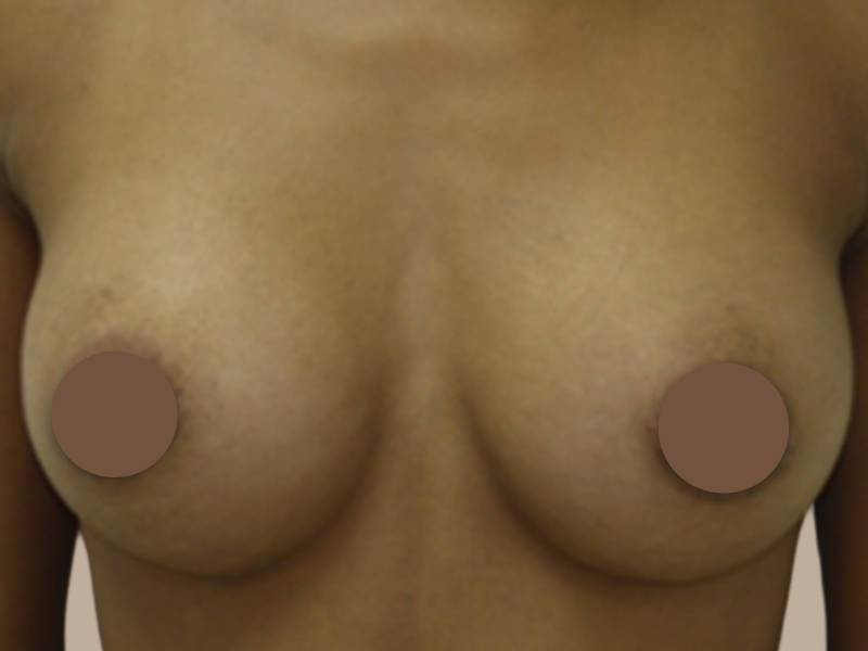 אחרי הגדלת חזה