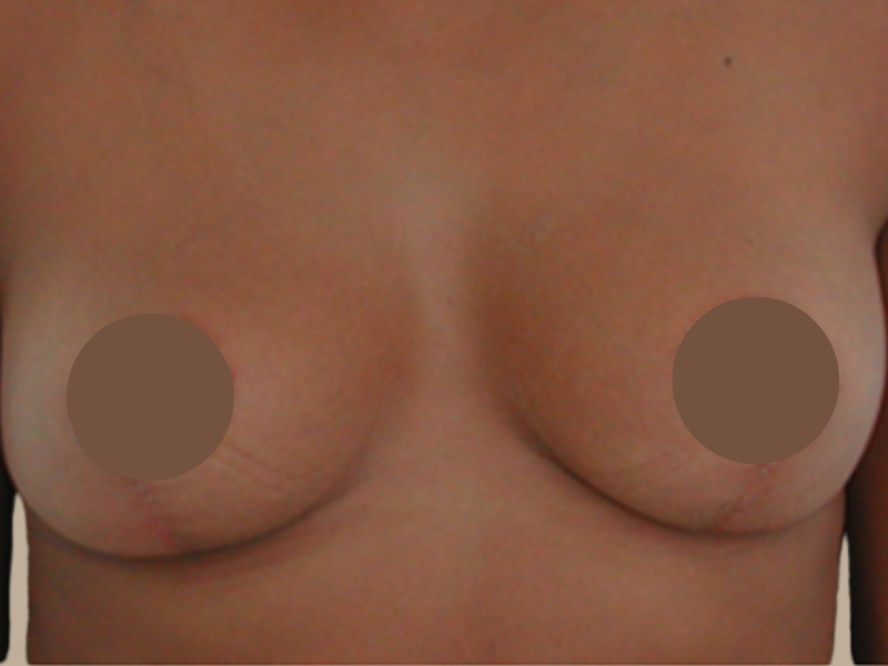 אחרי הרמת חזה