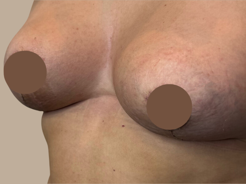 אחרי הרמת חזה