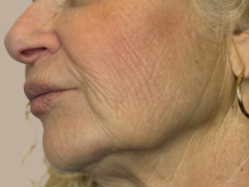 אחרי פיגמנטציה