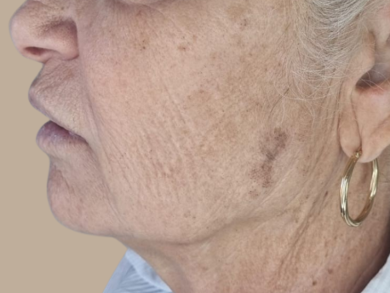 לפני פיגמנטציה