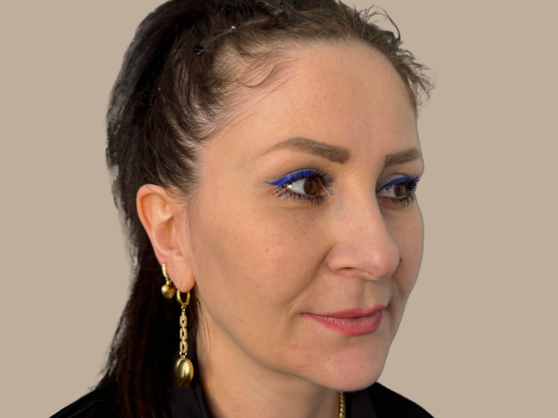 אחרי ניתוח עפעפיים