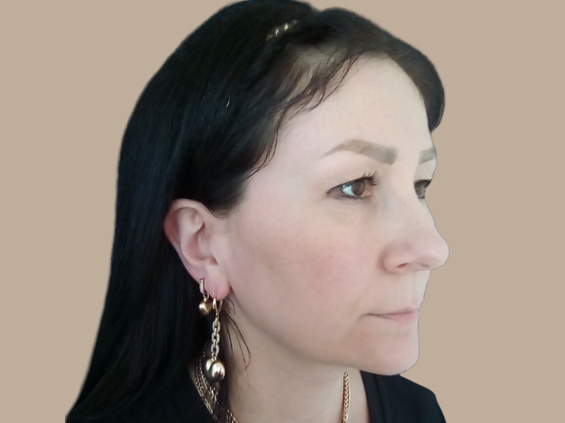 לפני ניתוח עפעפיים