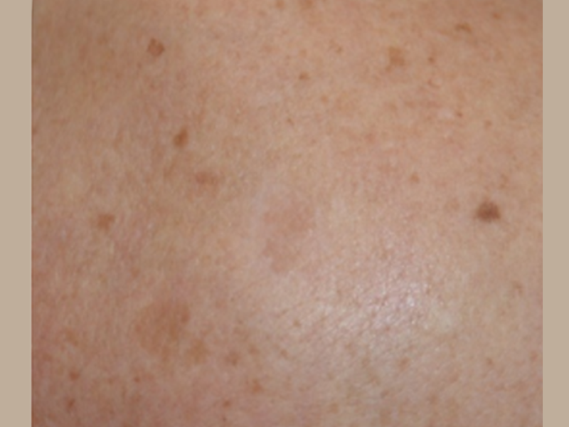 אחרי יובל פיגמנטציה