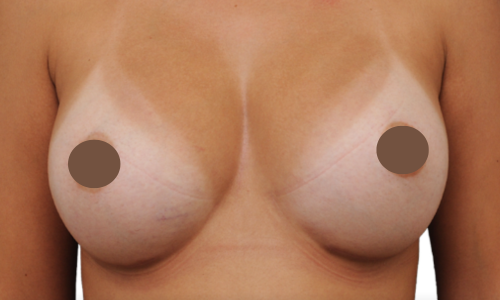 אחרי הגדלת חזה