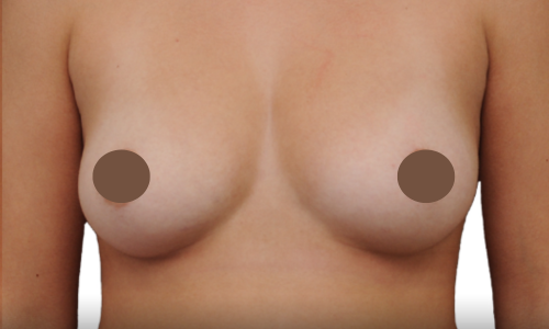 לפני הגדלת חזה