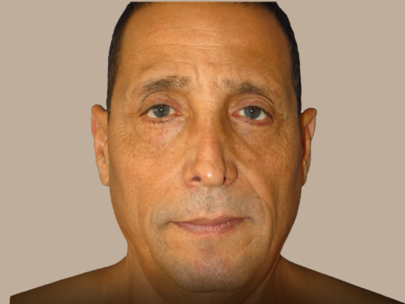 אחרי ניתוח עפעפיים