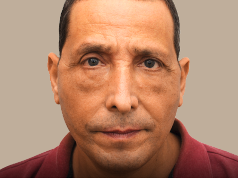 לפני ניתוח עפעפיים