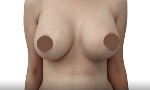 אחרי הגדלת חזה