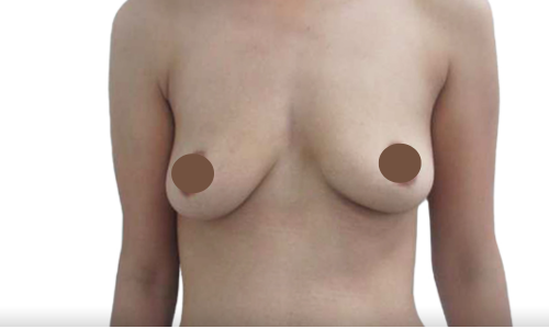 לפני הגדלת חזה