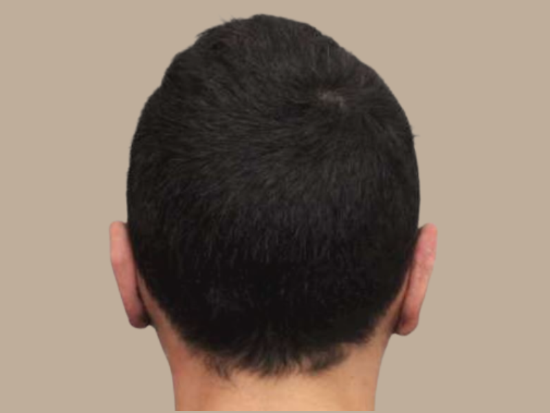 יובל אחרי הצמדת אוזניים