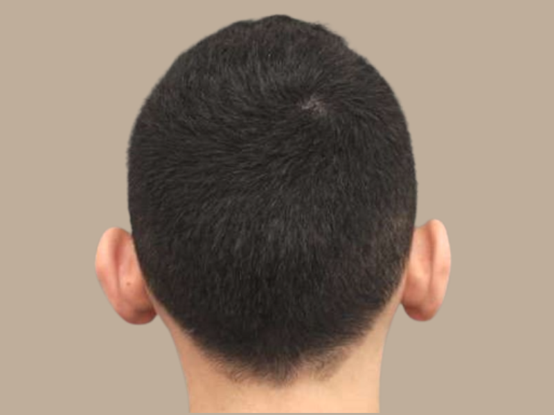 יובל אחרי הצמדת אוזניים