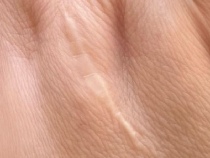 רחלי לפני צלקת