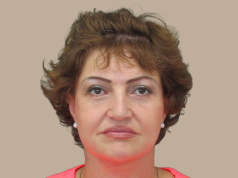 אחרי מתיחת פנים