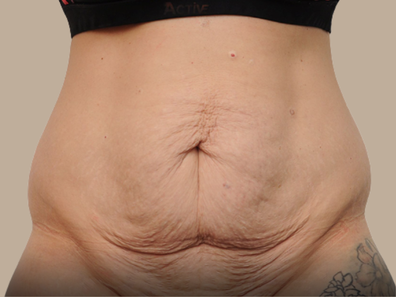 לפני שאיבת שומן