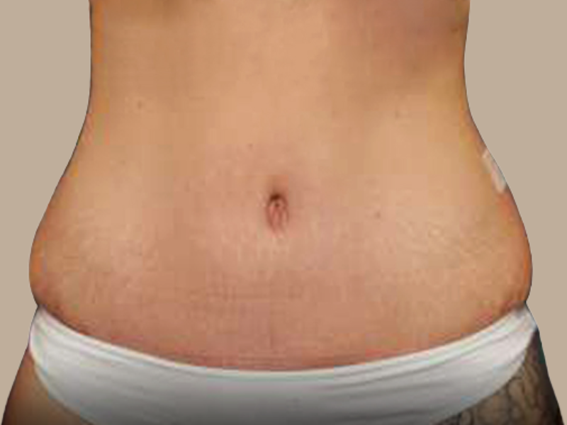 אחרי שאיבת שומן