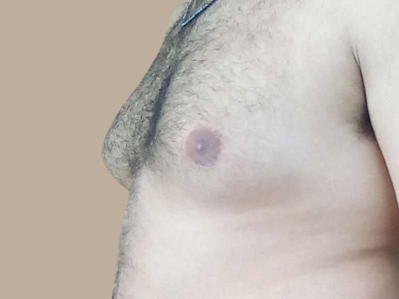 גניקומסטיה לפני