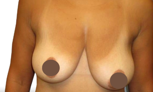 לפני הרמת חזה