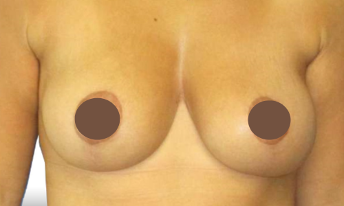 אחרי הרמת חזה