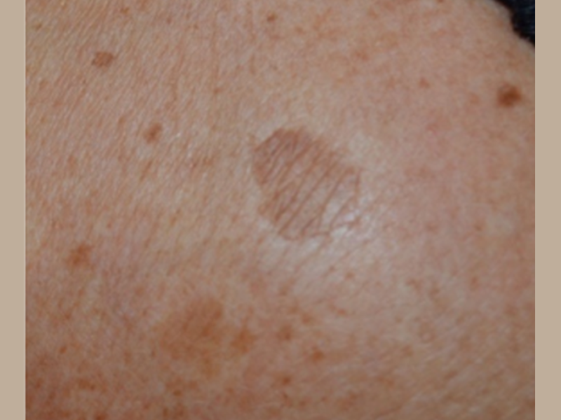 לפני פיגמנטציה