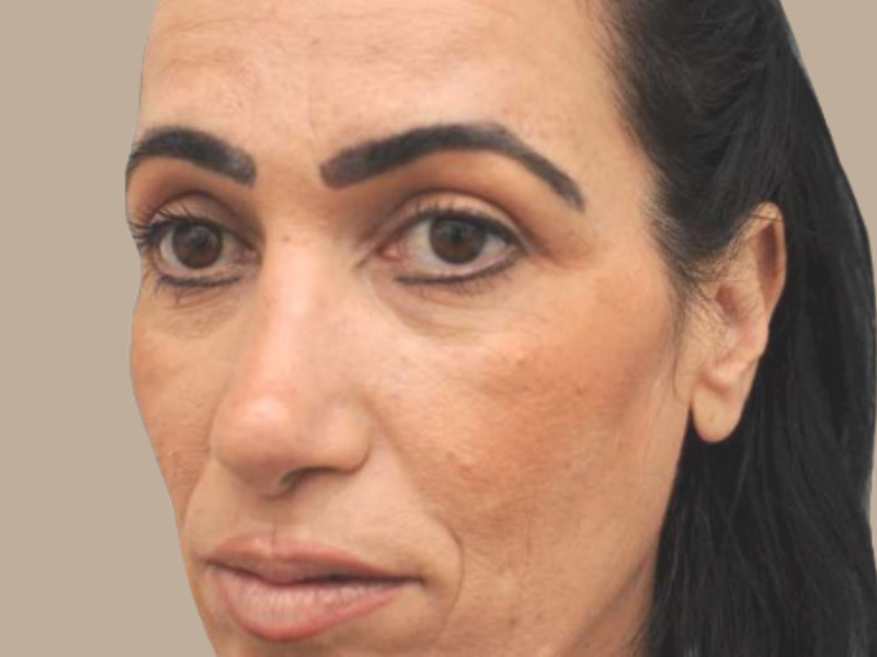 אחרי ניתוח עפעפיים