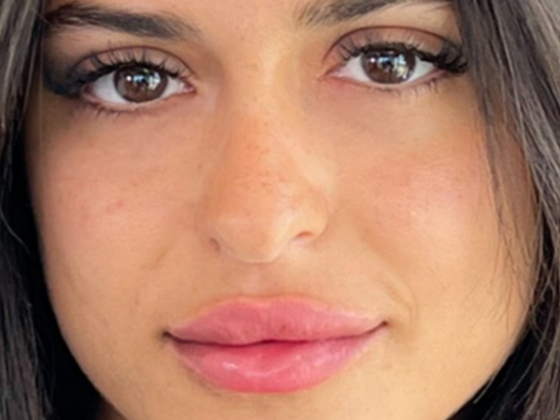 אחריי שקעי עיניים