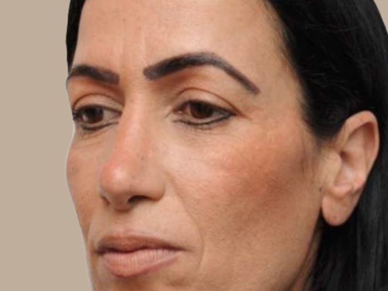 לפני ניתוח עפעפיים