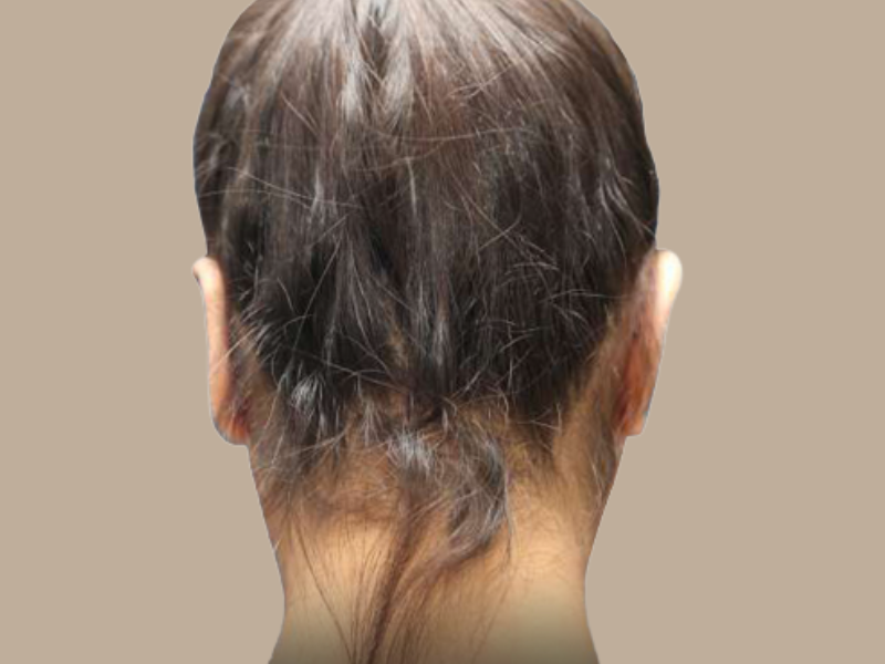 עדן אחרי הצמדת אוזניים