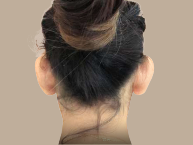 עדן לפני הצמדת אוזניים