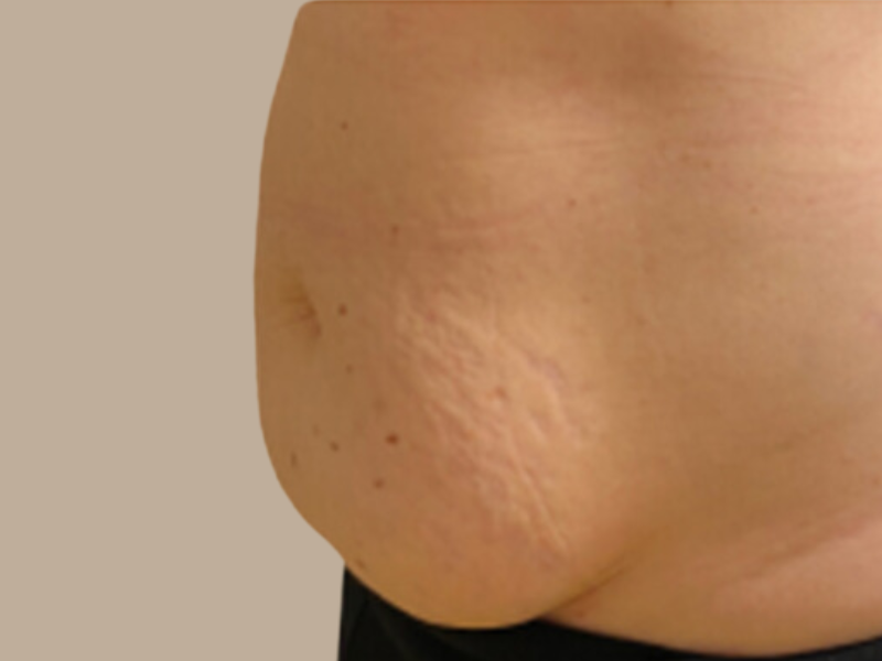 סימני מתיחה אחרי