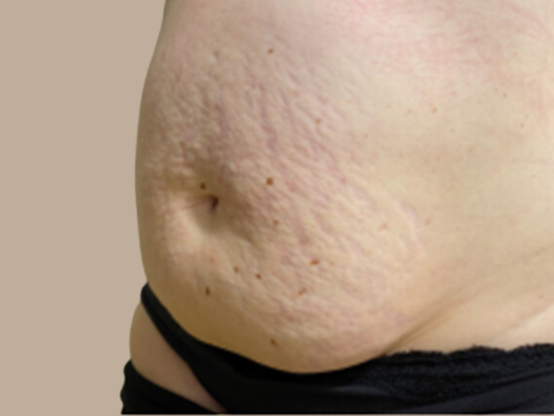 סימני מתיחה לפני